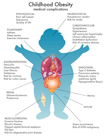 "child obesity"